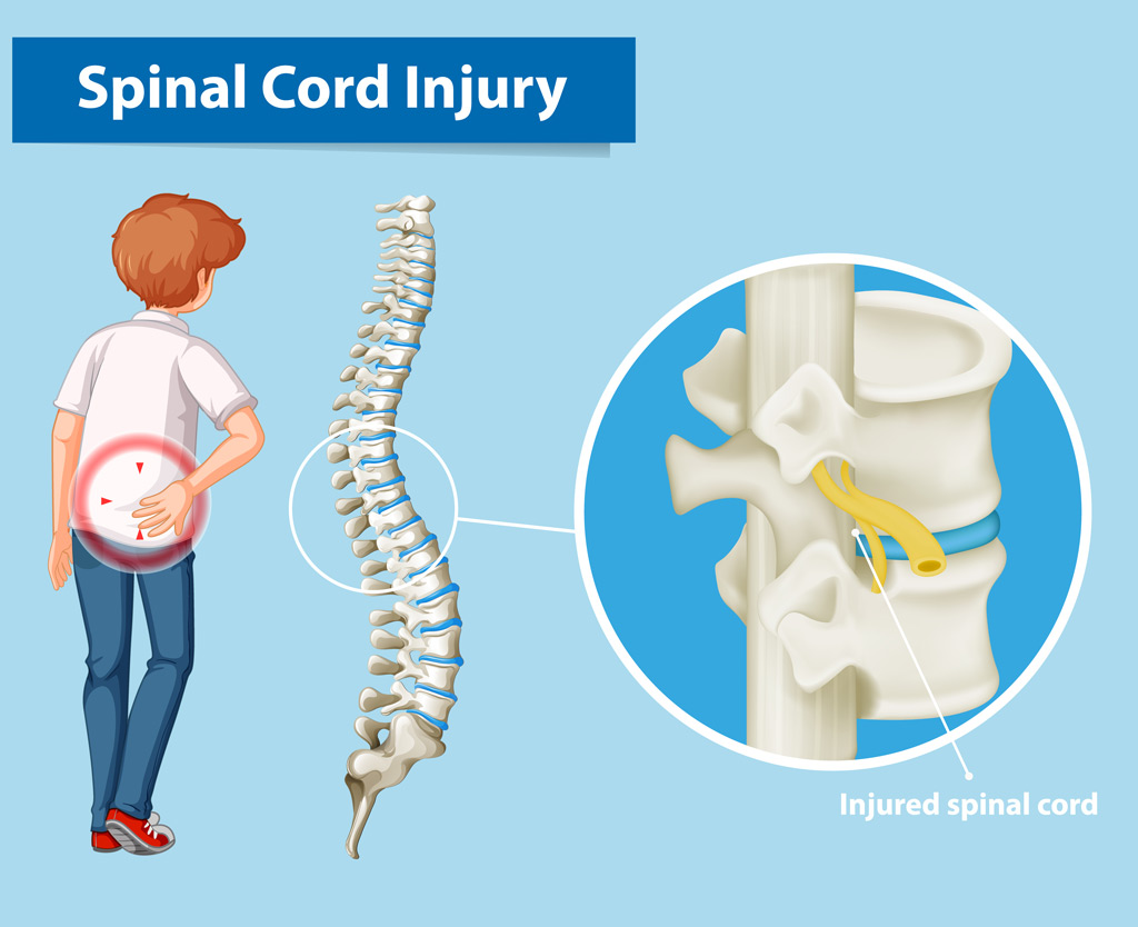 Back and spinal injury claims Back and spinal injury claims